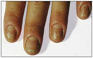 Paronychia - nagelbandsinflammation
